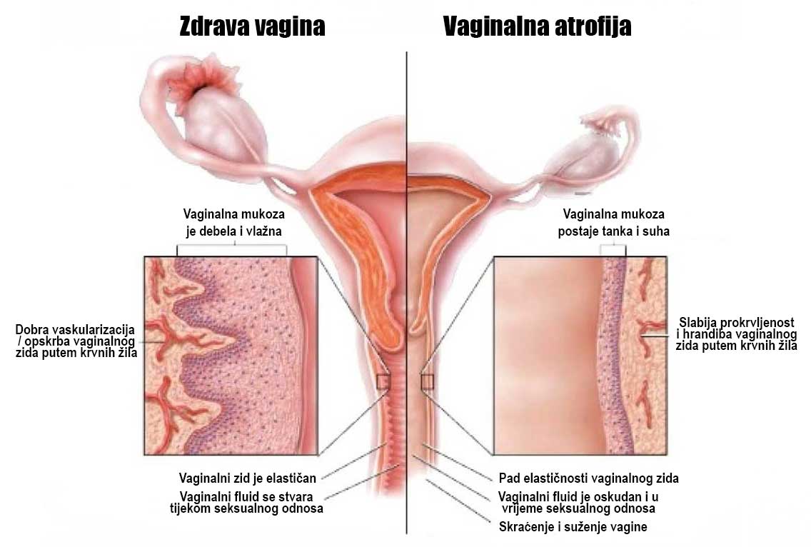 bol u vaginalnom zglobu uzrokuje liječenje